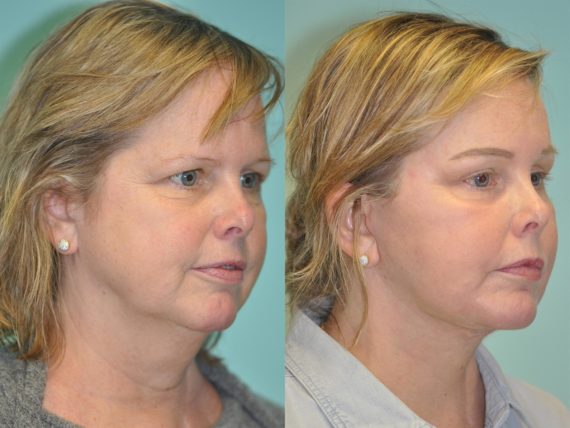 Before and after Facelift by Dr. Shervin Naderi, Patient 12639