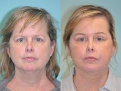 Facelift before and after at The Naderi Center, Reston, VA and Chevy Chase, MD, Patient 12639