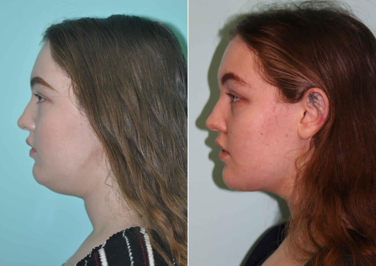 Before and after Neck Liposuction by Dr. Shervin Naderi, Patient 12726