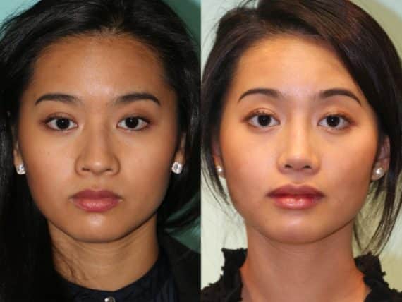 Before and after Rhinoplasty by Dr. Shervin Naderi, Patient 12632