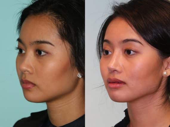 Before and after Rhinoplasty by Dr. Shervin Naderi, Patient 12632