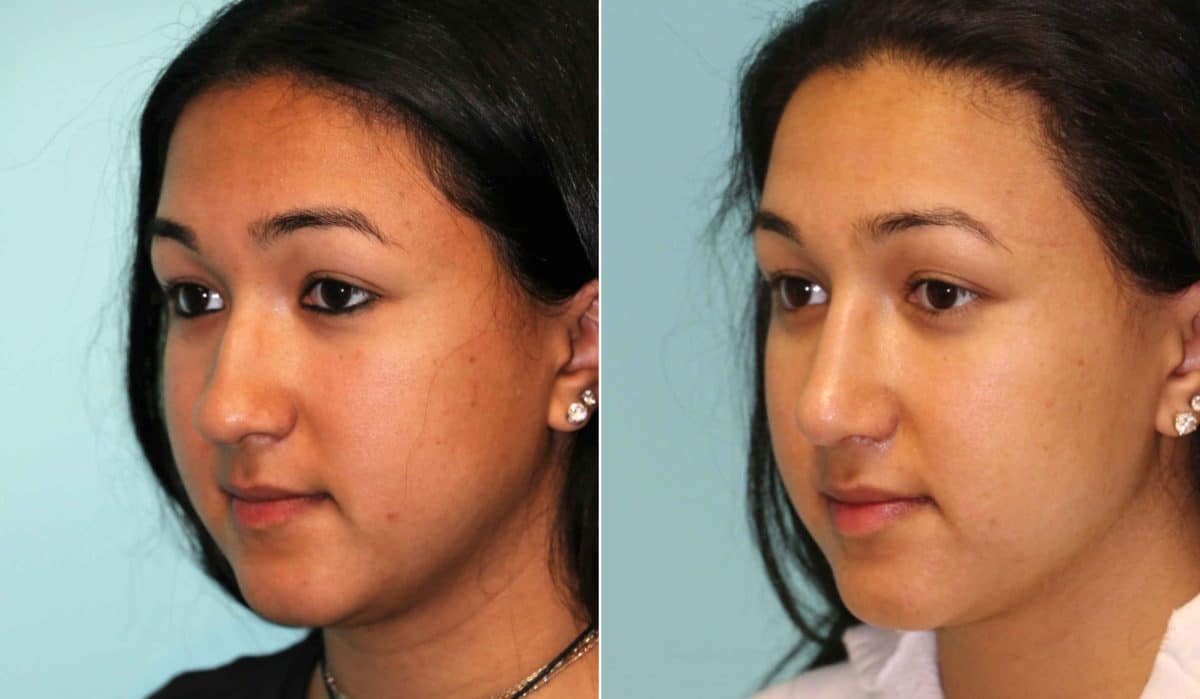 Before and after Rhinoplasty by Dr. Shervin Naderi, Patient 12696