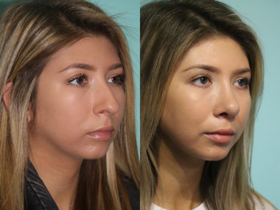 Before and after Rhinoplasty by Dr. Shervin Naderi, Patient 12628