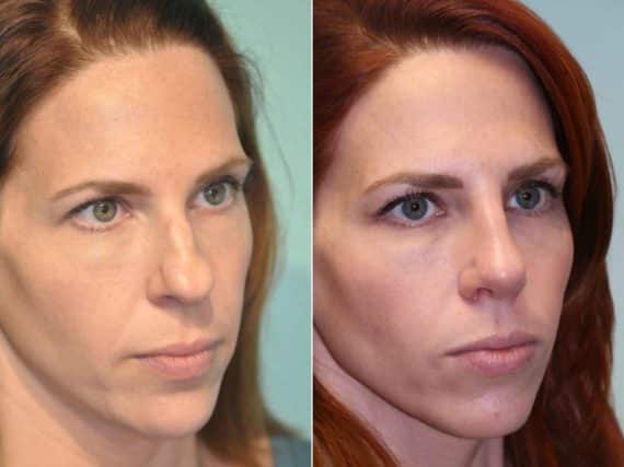 Before and after Rhinoplasty by Dr. Shervin Naderi, Patient 12719