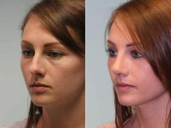 Before and after Rhinoplasty by Dr. Shervin Naderi, Patient 12779