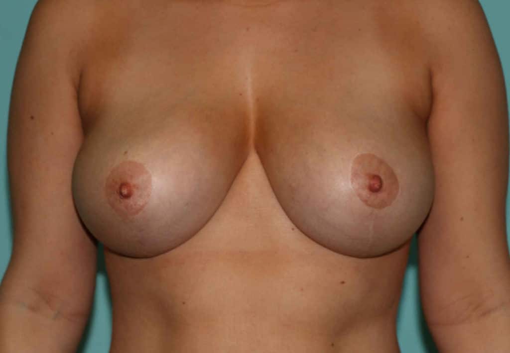 Front view after Breast Lift at The Naderi Center for Plastic Surgery and Dermatology | Virginia | Maryland | Chevy Chase - Top place for breast lift
