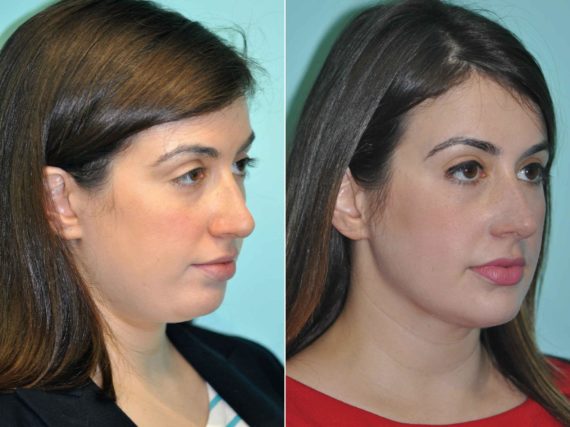 Before and after Neck Liposuction by Dr. Shervin Naderi, Patient 12809