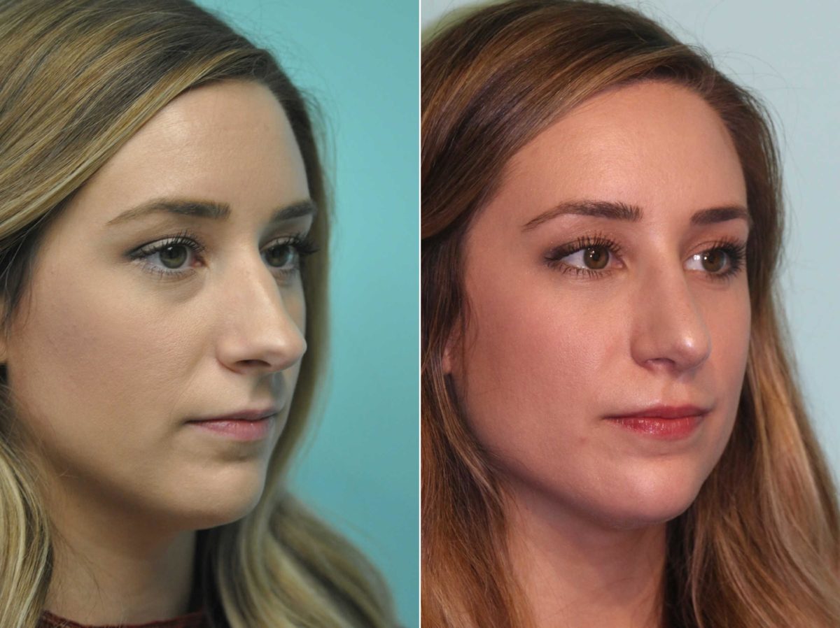 Before and after Rhinoplasty by Dr. Shervin Naderi, Patient 12985