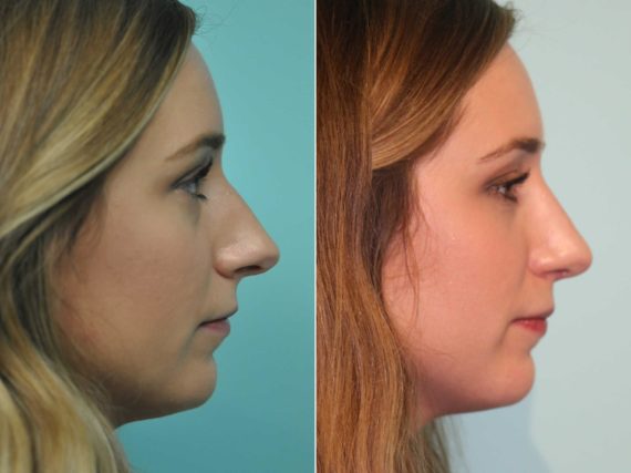 Before and after Rhinoplasty by Dr. Shervin Naderi, Patient 12985