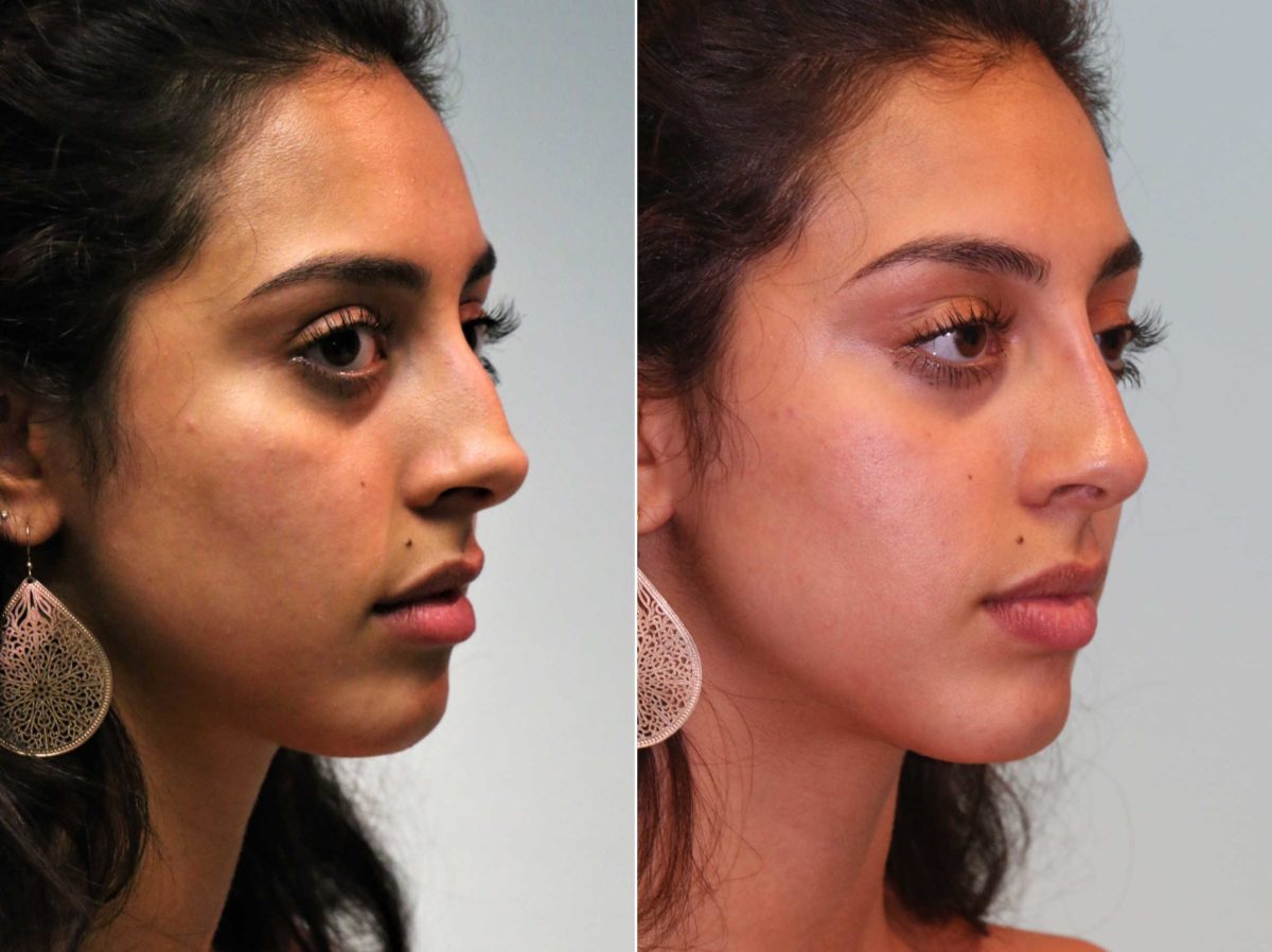 Before and after Non-Surgical Rhinoplasty by Dr. Shervin Naderi, Patient 12995