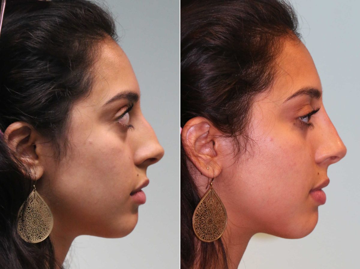 Before and after Non-Surgical Rhinoplasty by Dr. Shervin Naderi, Patient 12995