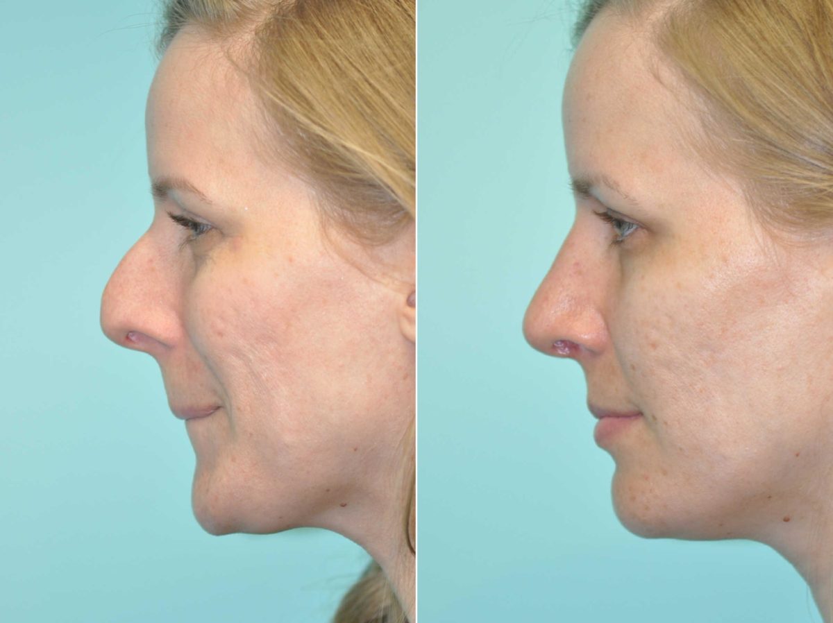 Before and after Rhinoplasty by Dr. Shervin Naderi, Patient 13002