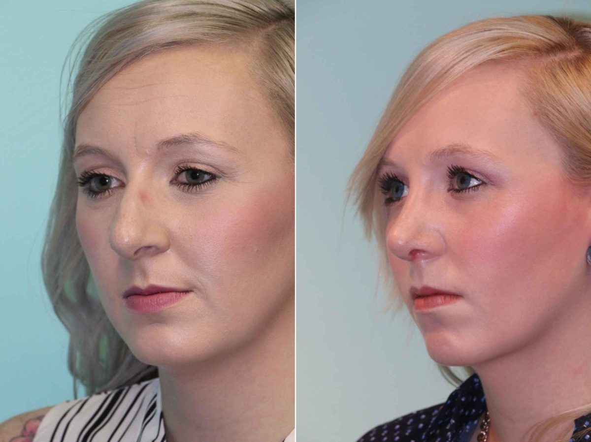 Before and after Rhinoplasty by Dr. Shervin Naderi, Patient 12885