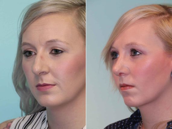 Before and after Rhinoplasty by Dr. Shervin Naderi, Patient 12885