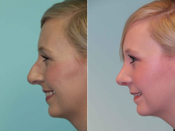 Before and after Rhinoplasty by Dr. Shervin Naderi, Patient 12885