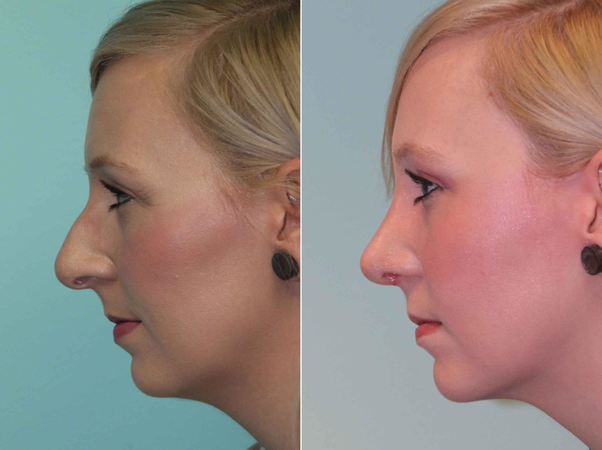 Before and after Rhinoplasty by Dr. Shervin Naderi, Patient 12885