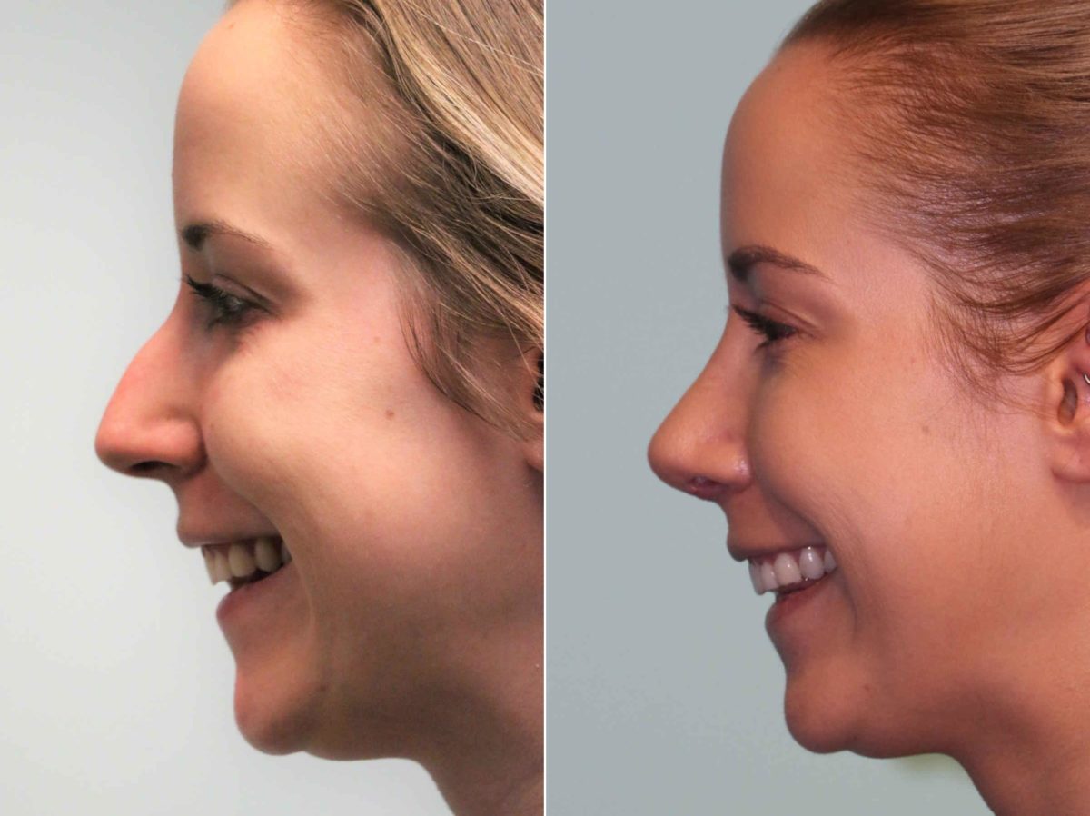 Before and after Rhinoplasty by Dr. Shervin Naderi, Patient 12935