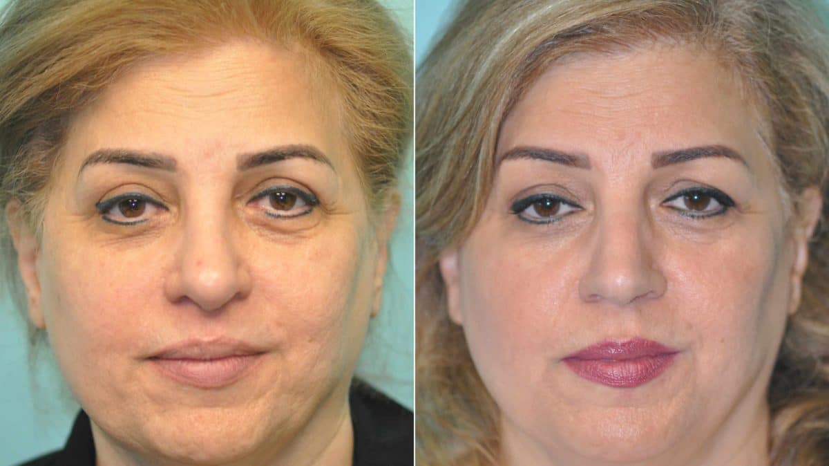 Before and after Rhinoplasty by Dr. Shervin Naderi, Patient 12939