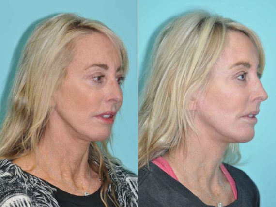 Before and after Skin Resurfacing by Dr. Shervin Naderi, Patient 12903