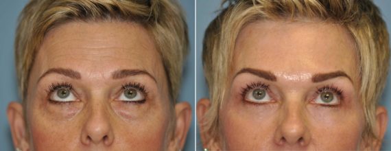 Before and after Blepharoplasty by Dr. Shervin Naderi, Patient 13041