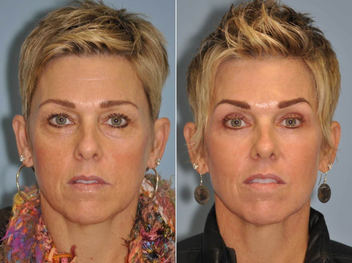 Before and after Blepharoplasty by Dr. Shervin Naderi, Patient 13041