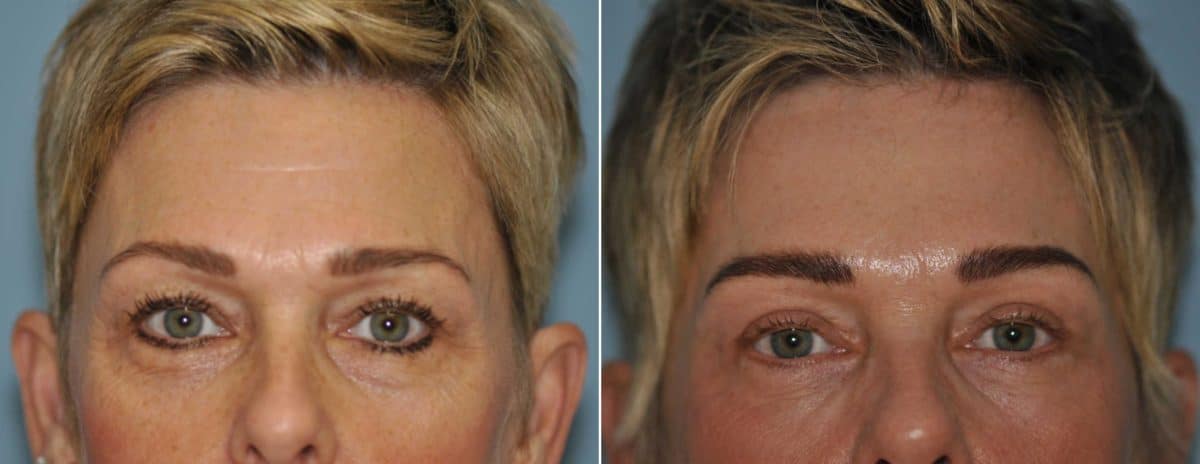 Before and after Blepharoplasty by Dr. Shervin Naderi, Patient 13041