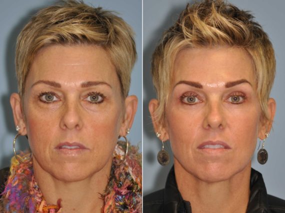 Before and after Blepharoplasty by Dr. Shervin Naderi, Patient 13041