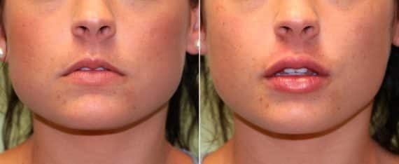 Before and after Lip Augmentation by Dr. Shervin Naderi, Patient 13083