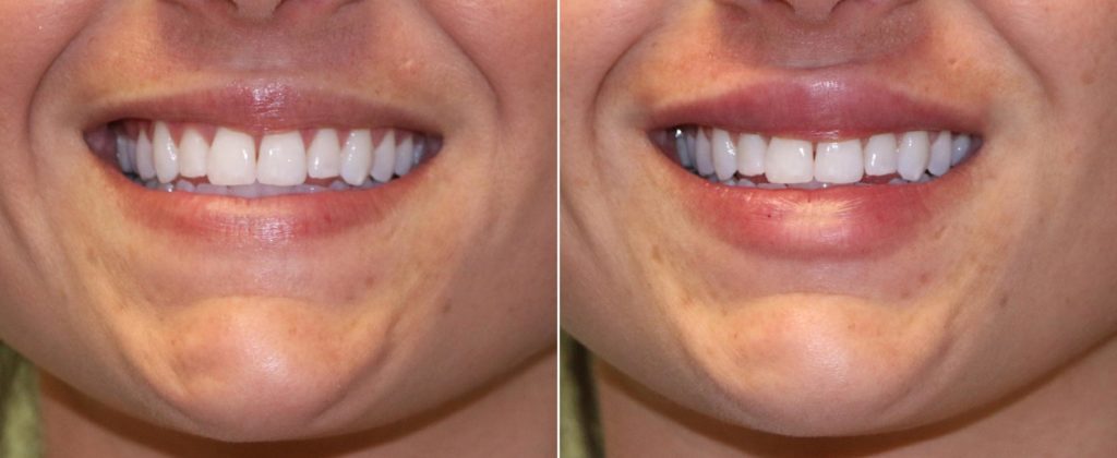 reduced gummy smile with lip injections using dermal fillers, done by top plastic surgeons at The Naderi Center in Virginia and Maryland