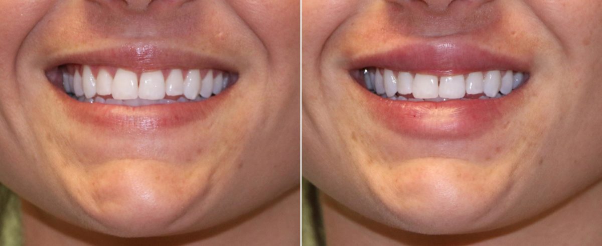 Before and after Lip Augmentation by Dr. Shervin Naderi, Patient 13083