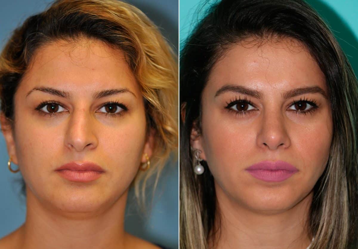 Before and after Rhinoplasty by Dr. Shervin Naderi, Patient 12709