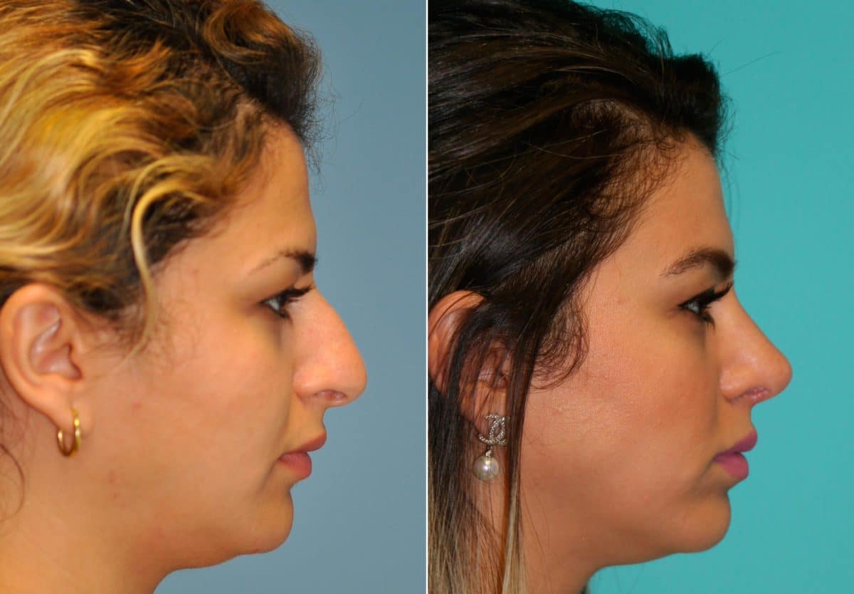 Before and after Rhinoplasty by Dr. Shervin Naderi, Patient 12709