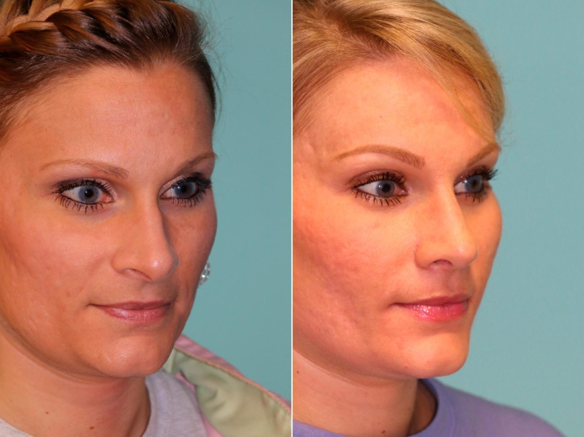 Before and after Rhinoplasty by Dr. Shervin Naderi, Patient 13171