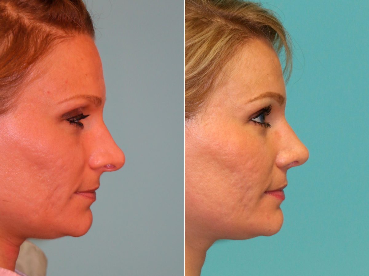 Before and after Rhinoplasty by Dr. Shervin Naderi, Patient 13171