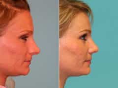 Before and after Rhinoplasty by Dr. Shervin Naderi, Patient 13171