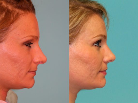 Before and after Rhinoplasty by Dr. Shervin Naderi, Patient 13171