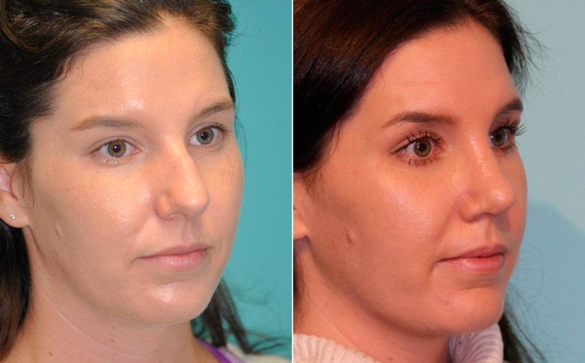 Before and after Rhinoplasty by Dr. Shervin Naderi, Patient 13076