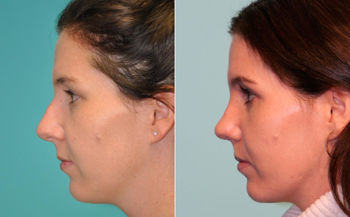 Before and after Rhinoplasty by Dr. Shervin Naderi, Patient 13076