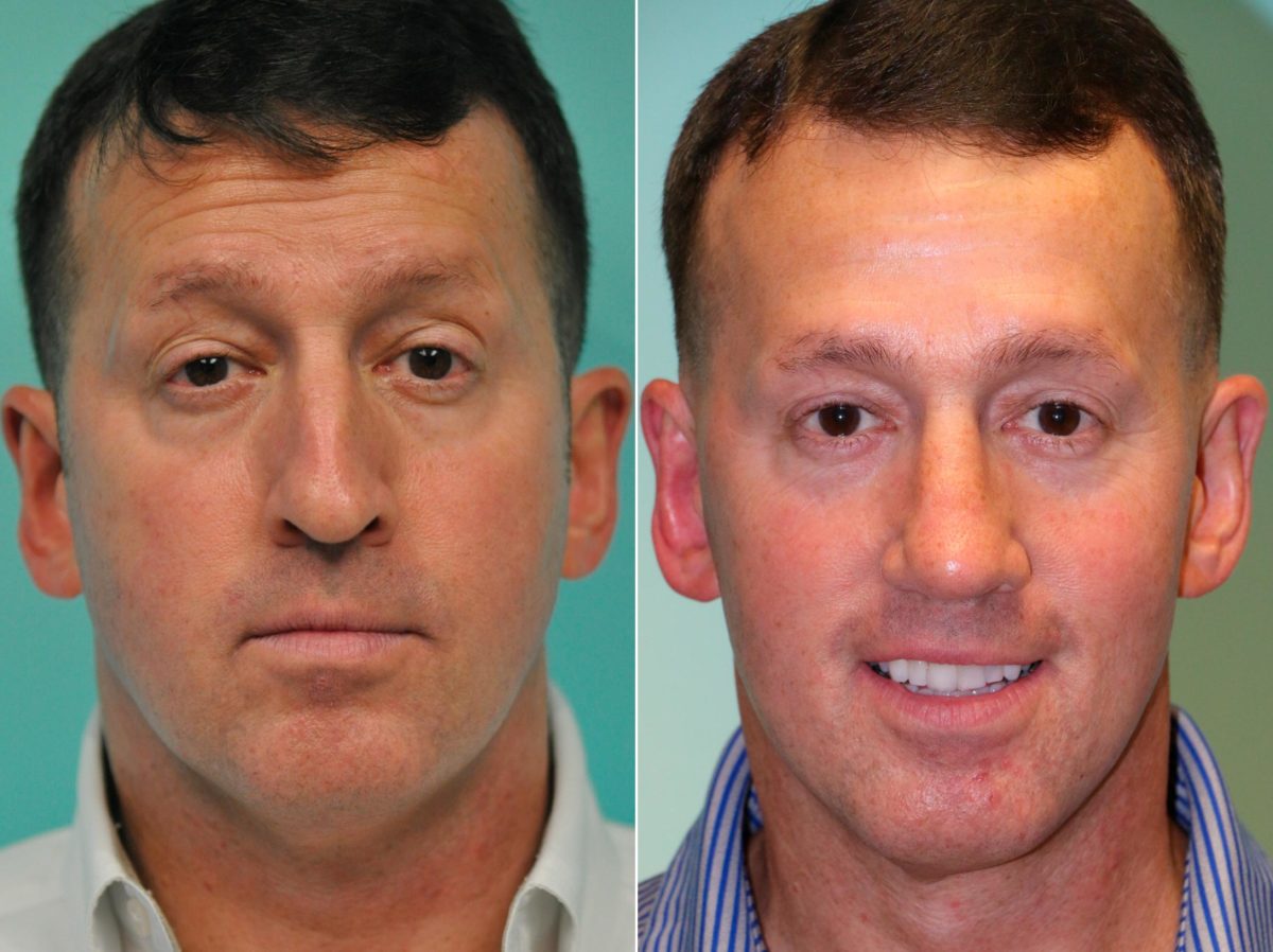 Before and after Rhinoplasty by Dr. Shervin Naderi, Patient 13162