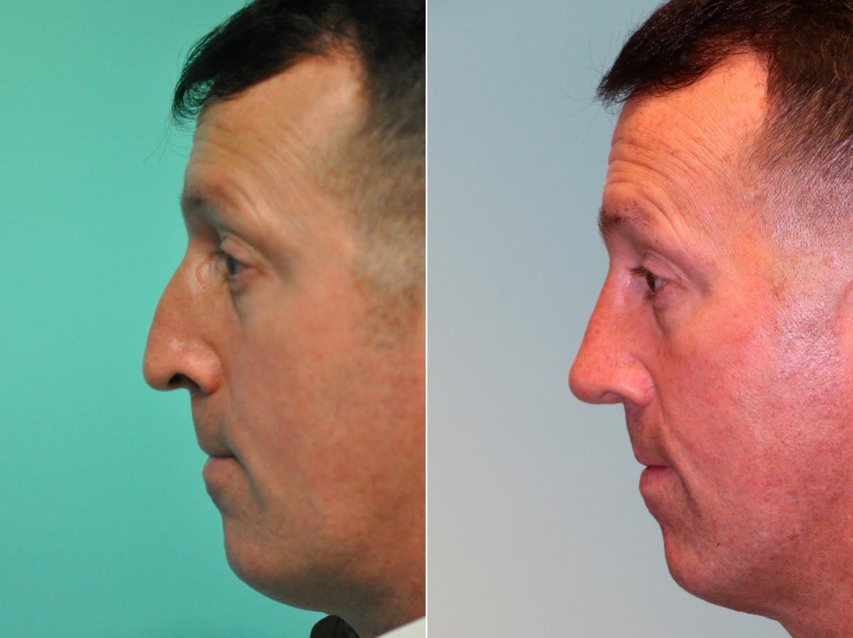 Before and after Rhinoplasty by Dr. Shervin Naderi, Patient 13162