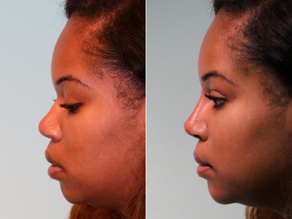 Before and after Non-Surgical Rhinoplasty by Dr. Shervin Naderi, Patient 13183