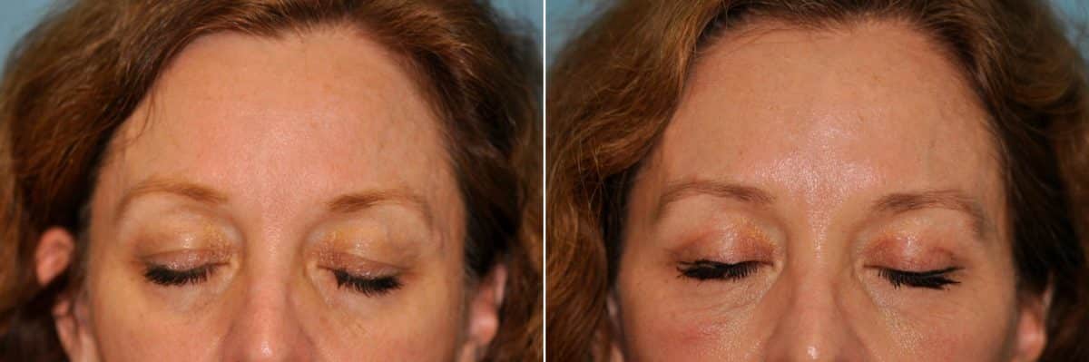 Before and after Blepharoplasty by Dr. Shervin Naderi, Patient 13294