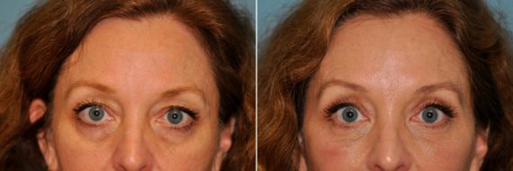 Before and after Blepharoplasty by Dr. Shervin Naderi, Patient 13294