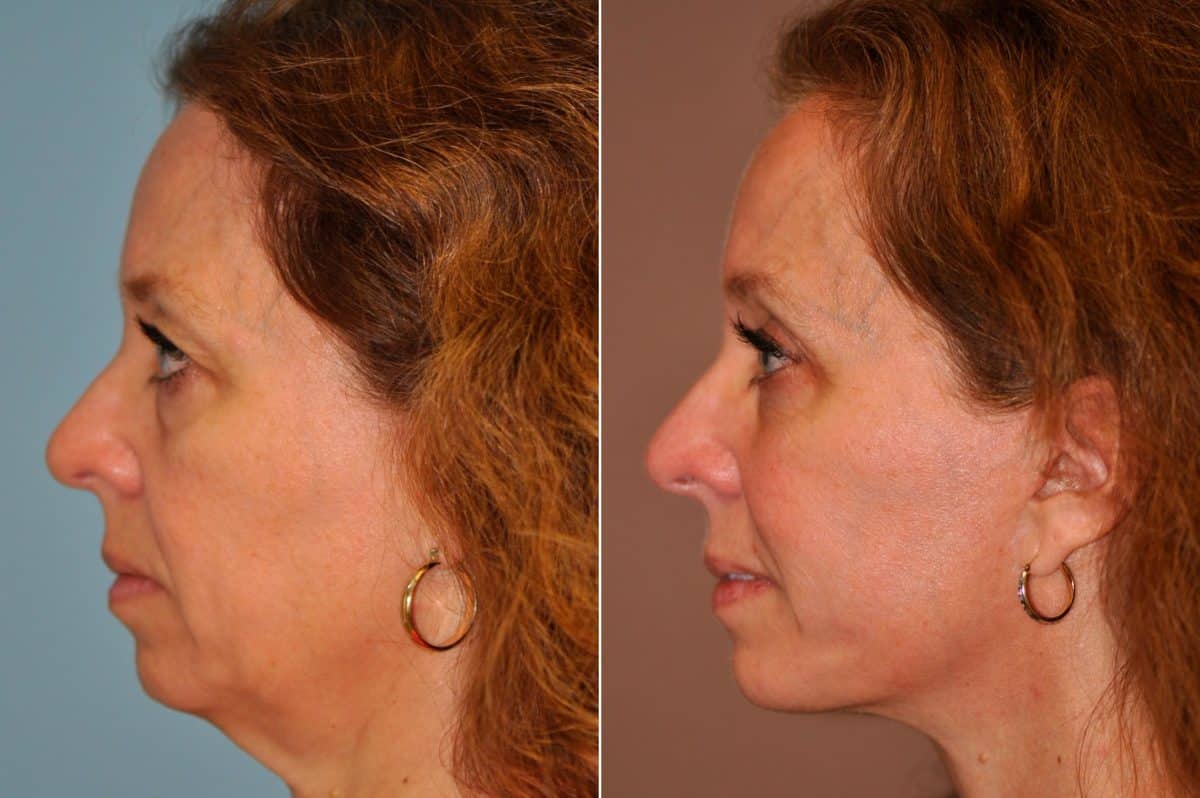 Before and after Facelift by Dr. Shervin Naderi, Patient 13287