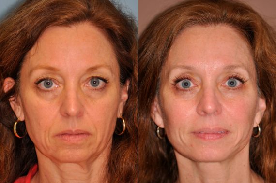 Before and after Facelift by Dr. Shervin Naderi, Patient 13287