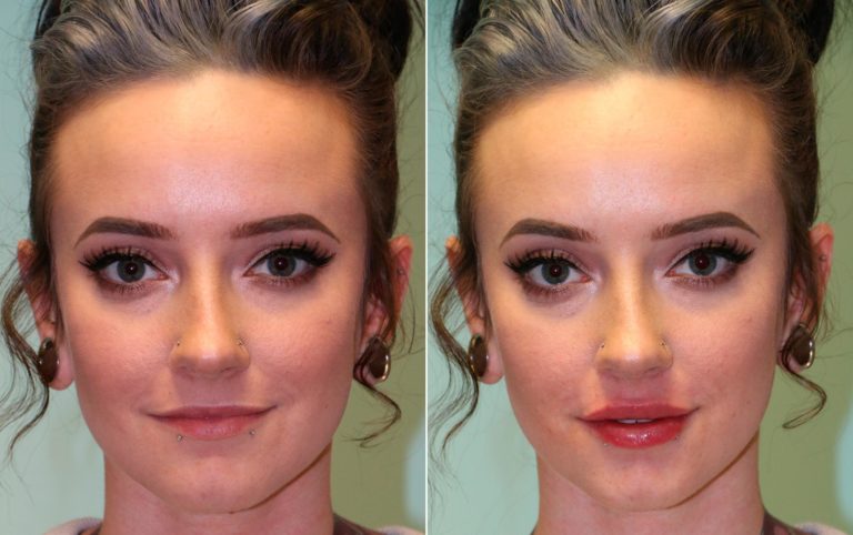 Lip Injections before and after photos - Plastic Surgery | Chevy Chase