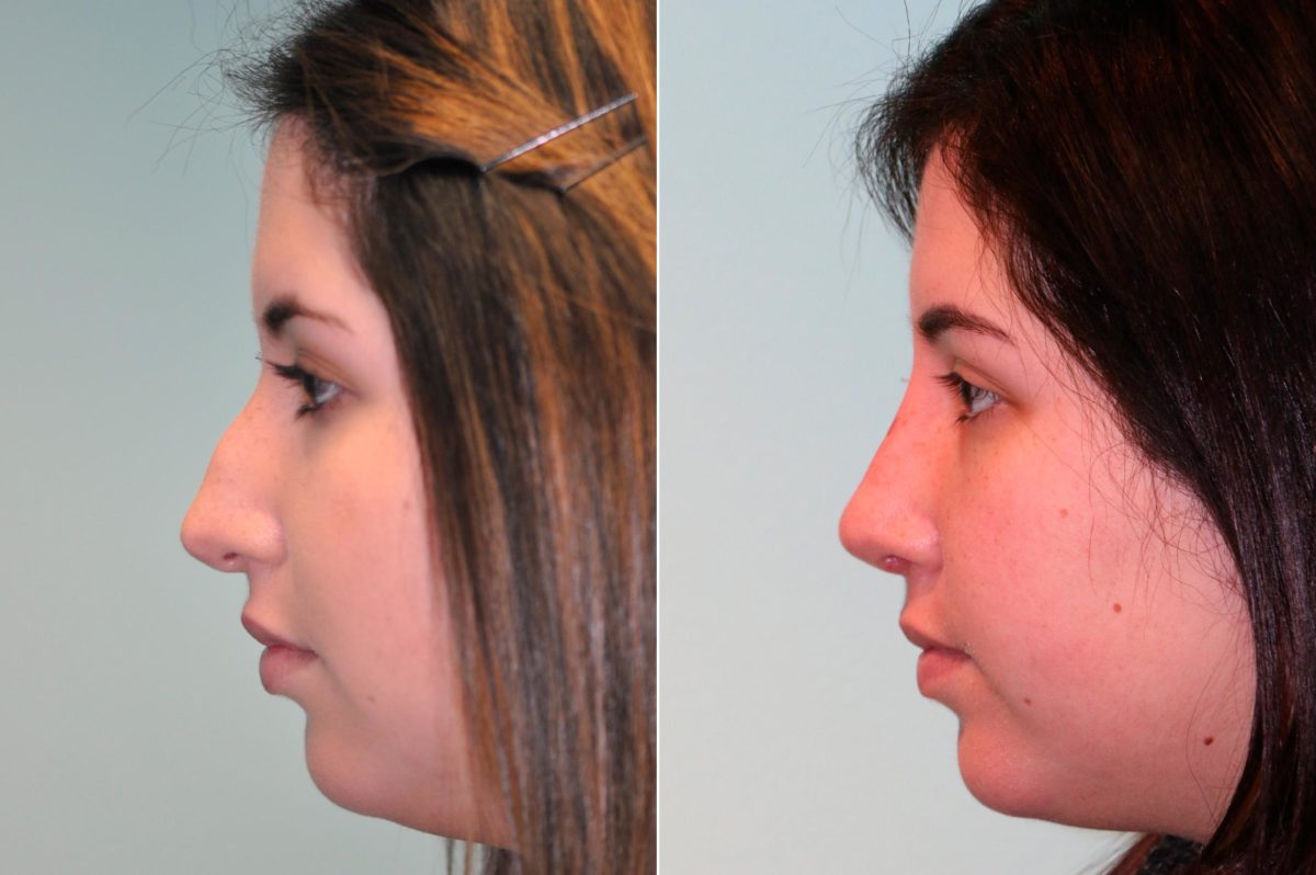 Before and after Rhinoplasty by Dr. Shervin Naderi, Patient 12701