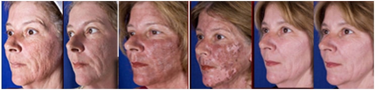 Co2 Skin Resurfacing