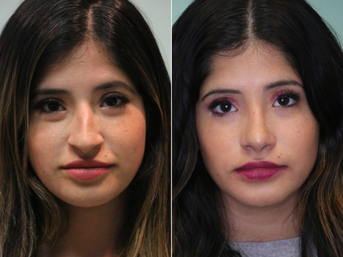 Before and after Rhinoplasty by Dr. Shervin Naderi, Patient 13069