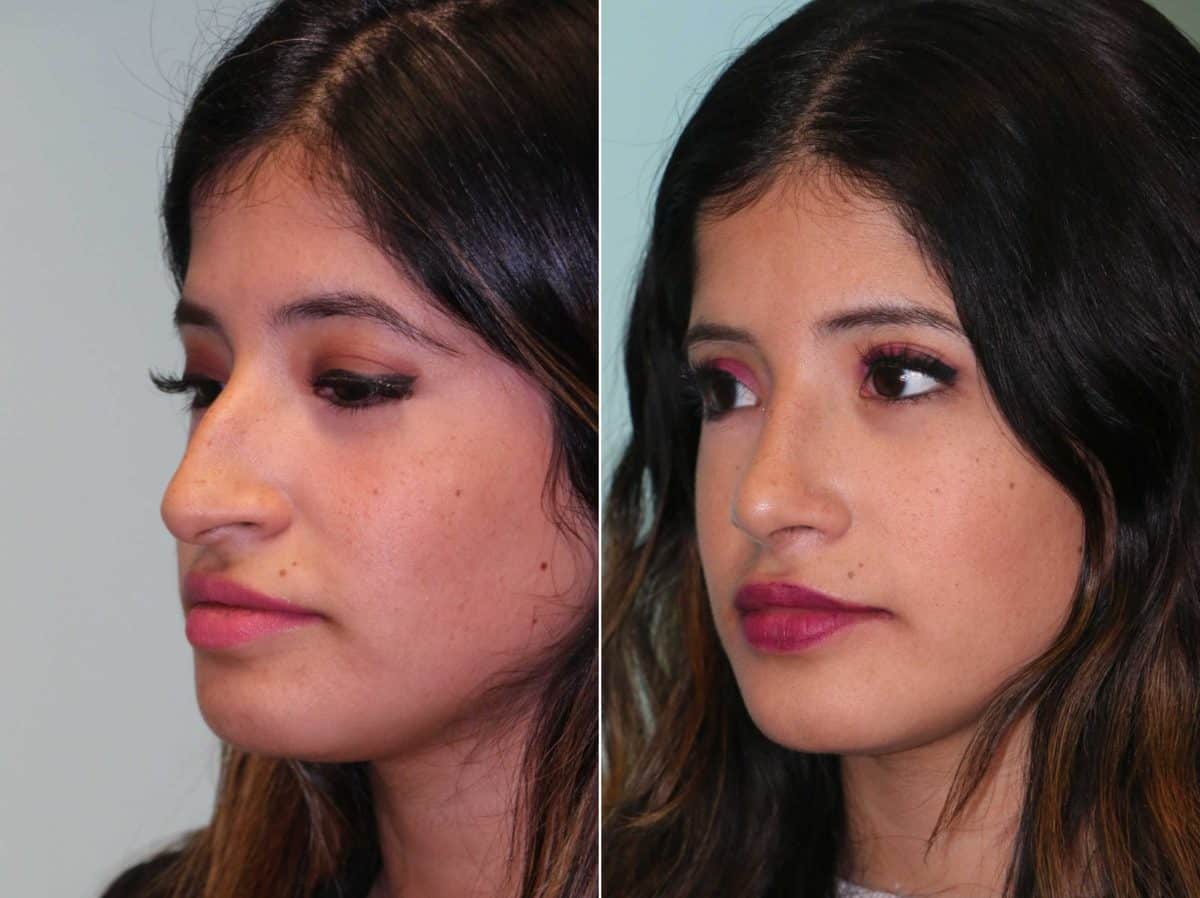 Before and after Rhinoplasty by Dr. Shervin Naderi, Patient 13069